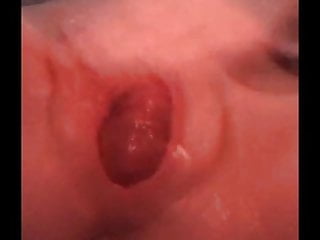 Cervix Prolapse, Homemade, Cervix